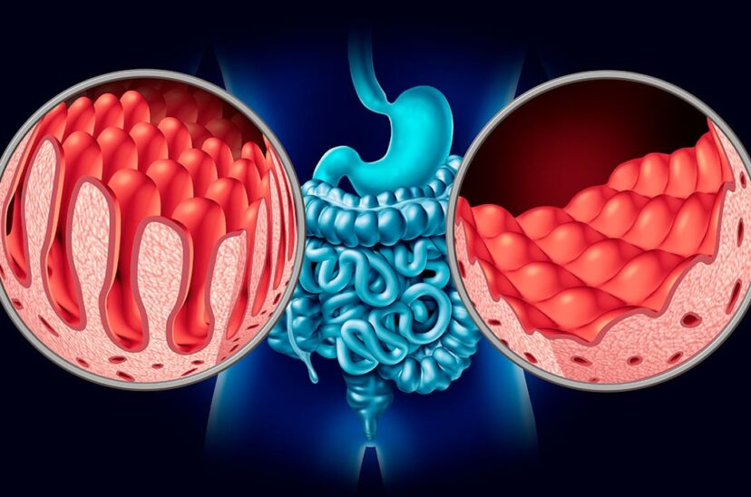 Alimentos para quienes padecen celíaca